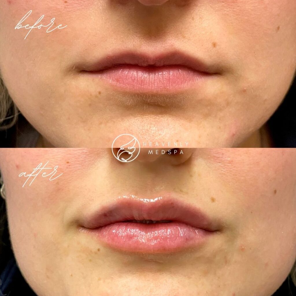 lip filler, dermal filler, lip filler orange county, lip filler foothill ranch, lip filler lake forest, nurse injector, medspa, medspa lake forest, lip filler medspa, lip filler before and after, revanesse versa, versa before and after, lip filler before and after