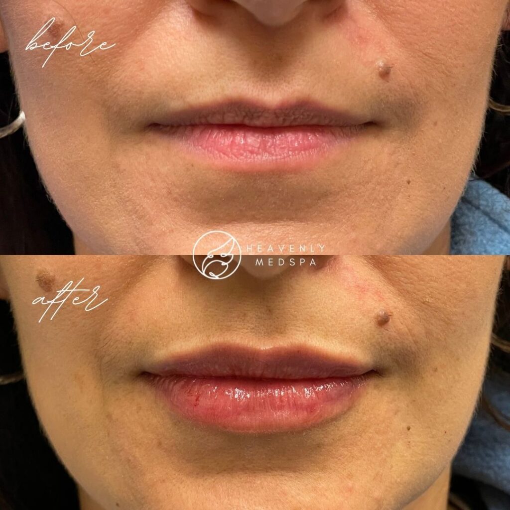 lip filler, dermal filler, lip filler orange county, lip filler foothill ranch, lip filler lake forest, nurse injector, medspa, medspa lake forest, lip filler medspa, lip filler before and after, revanesse versa, versa before and after, lip filler before and after