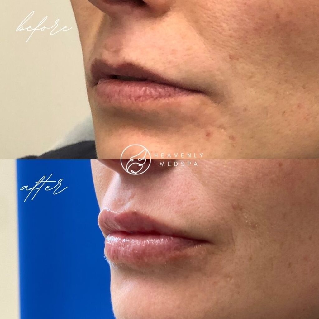 lip filler, dermal filler, lip filler orange county, lip filler foothill ranch, lip filler lake forest, nurse injector, medspa, medspa lake forest, lip filler medspa, lip filler before and after, revanesse versa, versa before and after, lip filler before and after