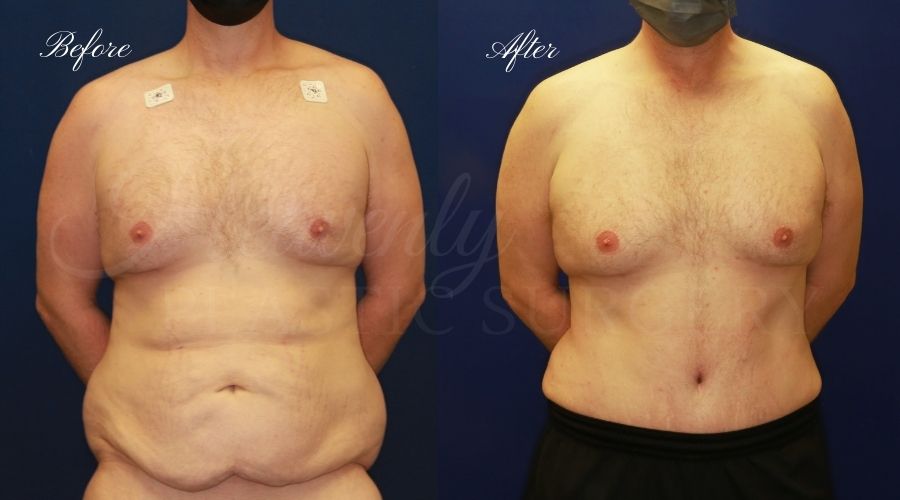 male tummy tuck, male tummy tuck before and after, tummy tuck before and after, male tummy tuck surgeon, tummy tuck orange county, male tummy tuck orange county, abdominoplasty surgeon, male abdominoplasty
