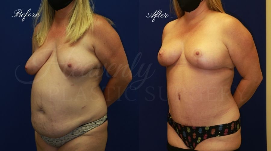 Mommy makeover before and after, mommy makeover surgery, breast lift surgery, tummy tuck surgery, breast lift before and after, tummy tuck before and after, mommy makeover surgeon, mommy makeover surgery, mommy makeover orange county, tummy tuck orange county, breast lift orange county, plastic surgery, plastic surgeon, plastic surgery before and after, mommy makeover journey, mommy makeover results, tummy tuck journey, tummy tuck results, plastic surgery results, orange county plastic surgeon, orange county plastic surgery, plastic surgery orange county Mommy makeover before and after, mommy makeover surgery, breast lift surgery, tummy tuck surgery, breast lift before and after, tummy tuck before and after, mommy makeover surgeon, mommy makeover surgery, mommy makeover orange county, tummy tuck orange county, breast lift orange county, plastic surgery, plastic surgeon, plastic surgery before and after, mommy makeover journey, mommy makeover results, tummy tuck journey, tummy tuck results, plastic surgery results, orange county plastic surgeon, orange county plastic surgery, plastic surgery orange county