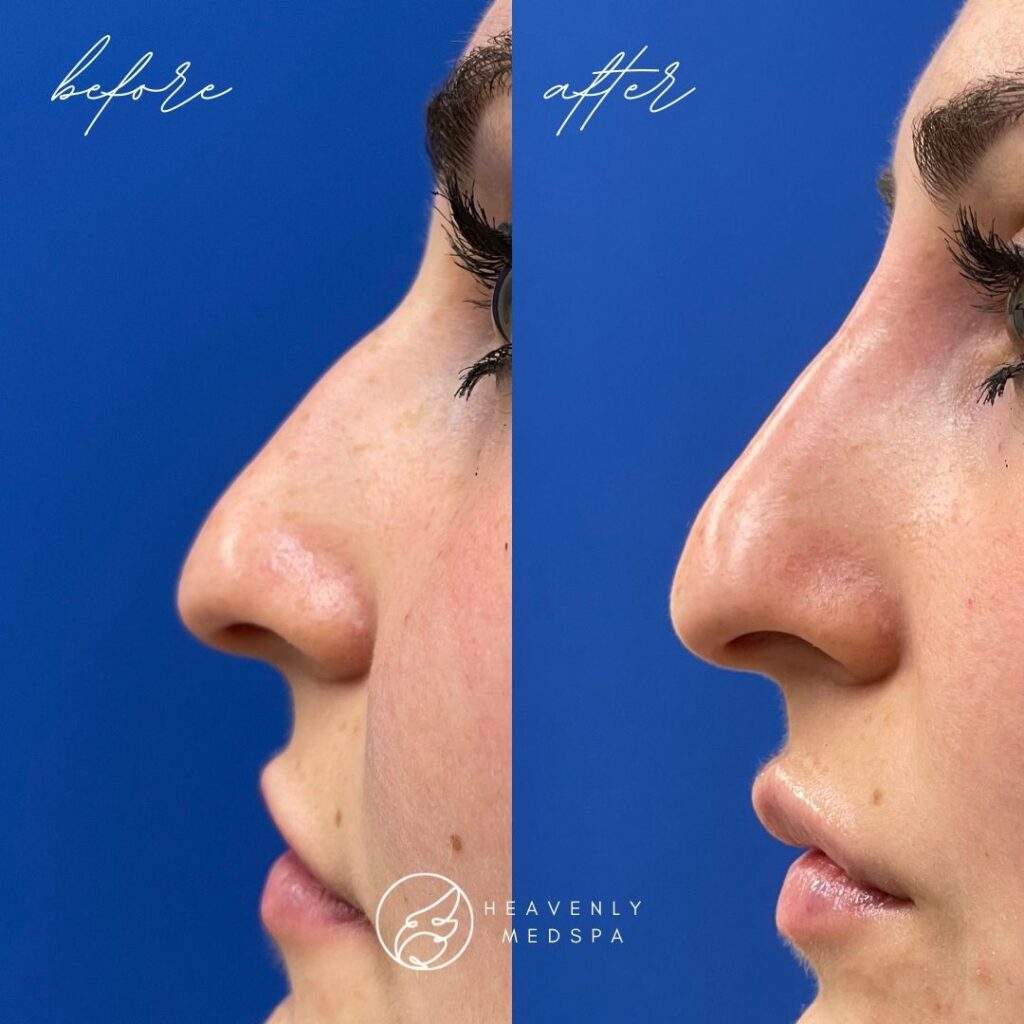 nose filler before and after, nose filler, nose filler orange county, non surgical rhinoplasty, non-surgical rhinoplasty, non surgical rhinoplasty orange county, dermal filler, nose dermal filler, hyaluronic acid filler