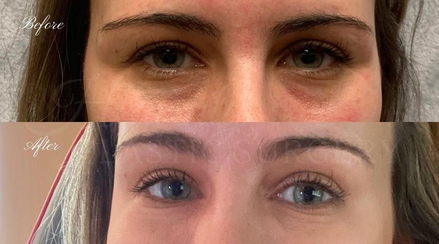 Tear trough filler, undereye filler, eye filler, dermal filler, nurse injector, medspa, filler medspa, filler orange county, under eye filler orange county, filler orange county Tear trough filler, undereye filler, eye filler, dermal filler, nurse injector, medspa, filler medspa, filler orange county, under eye filler orange county, filler orange county