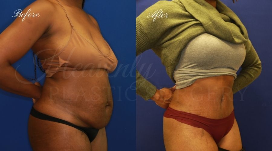 Plastic Surgery, Plastic Surgeon, Tummy Tuck, Abdominoplasty, Tummy Tuck with Lipo, Liposuction, Orange County Plastic Surgeon, Orange County Plastic Surgery, Fupa, Fupa surgery, fupa surgeon