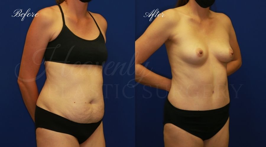 Plastic Surgery, Plastic Surgeon, Tummy Tuck, Abdominoplasty, Tummy Tuck with Lipo, Liposuction, Orange County Plastic Surgeon, Orange County Plastic Surgery, Fupa, Fupa surgery, fupa surgeon