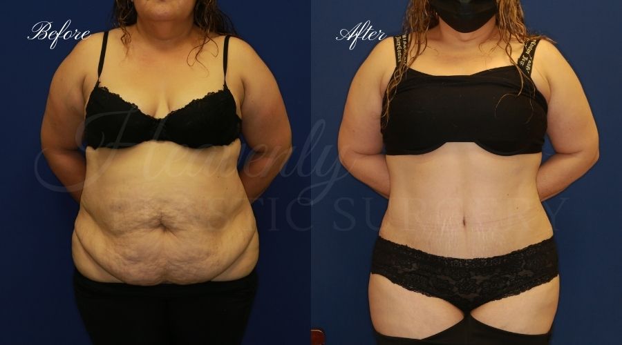 Plastic Surgery, Plastic Surgeon, Tummy Tuck, Abdominoplasty, Tummy Tuck with Lipo, Liposuction, Orange County Plastic Surgeon, Orange County Plastic Surgery, Fupa, Fupa surgery, fupa surgeon