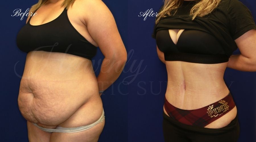 Plastic Surgery, Plastic Surgeon, Tummy Tuck, Abdominoplasty, Tummy Tuck with Lipo, Liposuction, Orange County Plastic Surgeon, Orange County Plastic Surgery, Fupa, Fupa surgery, fupa surgeon