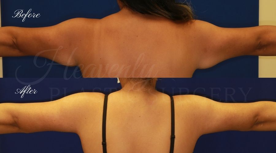 Arm lift, Brachioplasty, plastic surgery, plastic surgeon, massive weight loss Arm lift, Brachioplasty, plastic surgery, plastic surgeon, massive weight loss