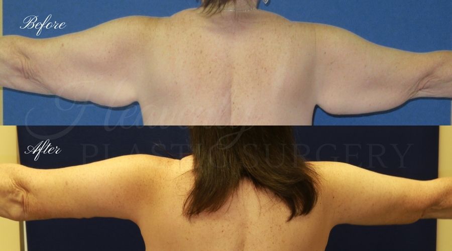 Plastic Surgery, Liposuction, Arm Lift, Brachioplasty, arms, bat wings Plastic Surgery, Liposuction, Arm Lift, Brachioplasty, arms, bat wings