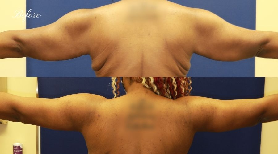 ARM LIFT GALLERY Heavenly Plastic Surgery