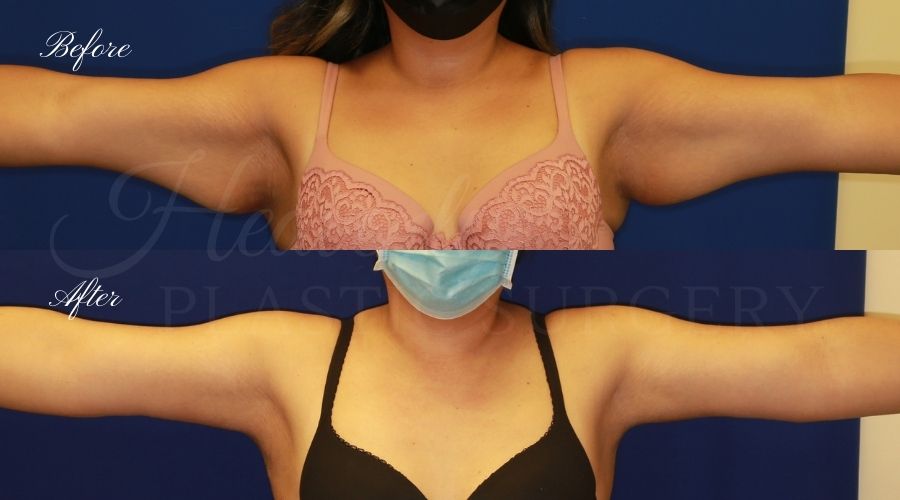 Arm lift, Brachioplasty, plastic surgery, plastic surgeon, massive weight loss