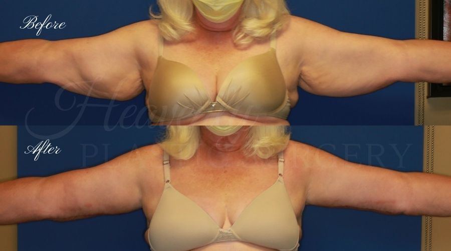 Plastic Surgery, plastic surgeon, mommy makeover, arm lift, abdominoplasty, brachioplasty, extra skin