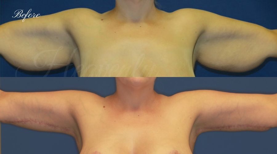 Mommy Makeover - Brachioplasty (Arm Lift), Breast Lift (Mastopexy) Breast Implants (330cc SRM silicone implants under the muscle), Body Lift, Liposuction