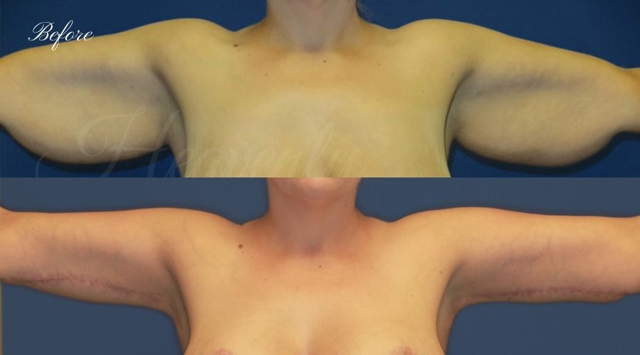 Mommy Makeover - Brachioplasty (Arm Lift), Breast Lift (Mastopexy) Breast Implants (330cc SRM silicone implants under the muscle), Body Lift, Liposuction Mommy Makeover - Brachioplasty (Arm Lift), Breast Lift (Mastopexy) Breast Implants (330cc SRM silicone implants under the muscle), Body Lift, Liposuction