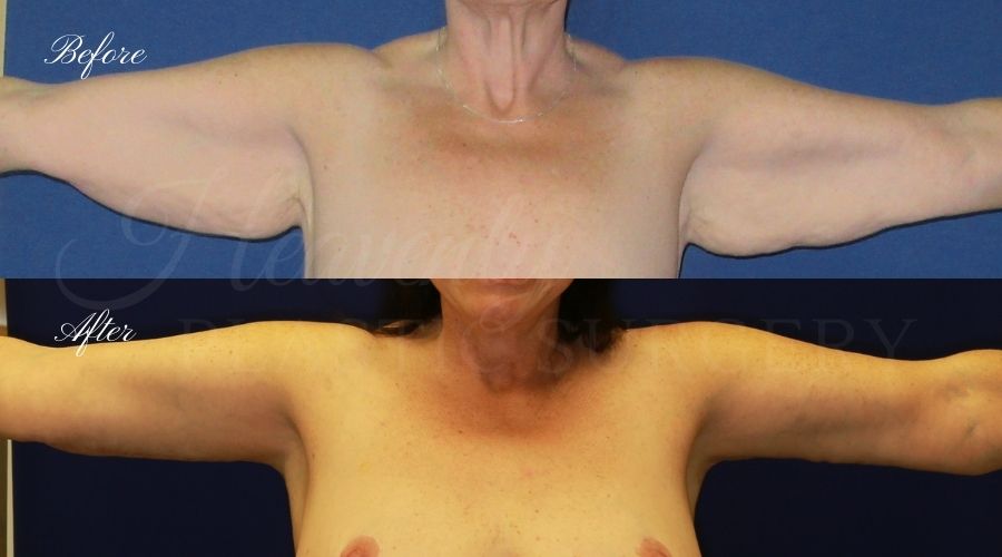 Plastic Surgery, Liposuction, Arm Lift, Brachioplasty, arms, bat wings Plastic Surgery, Liposuction, Arm Lift, Brachioplasty, arms, bat wings