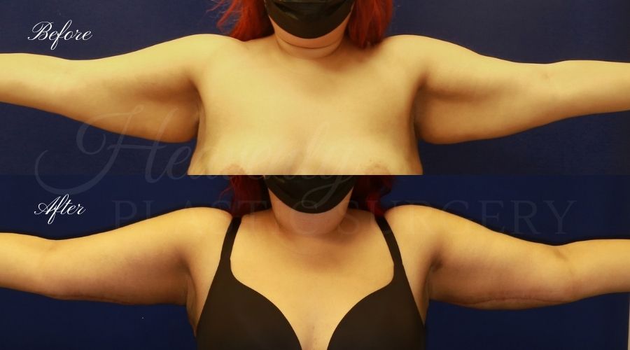 Plastic Surgery, Liposuction, Arm Lift, Brachioplasty, arms, bat wings Plastic Surgery, Liposuction, Arm Lift, Brachioplasty, arms, bat wings