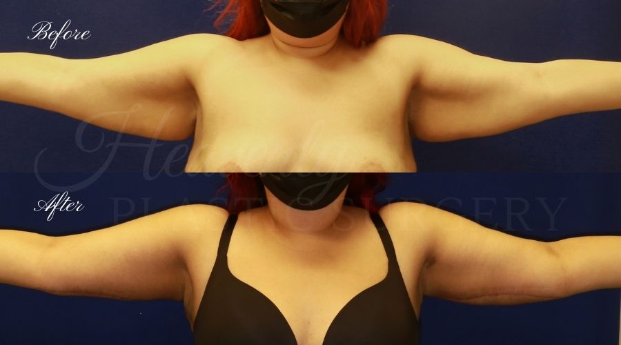 Plastic Surgery, Liposuction, Arm Lift, Brachioplasty, arms, bat wings