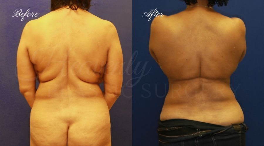 back lift surgery, back lift, back lift surgeon, weight loss surgeon, back surgery, back lift before and after, back lift orange county back lift surgery, back lift, back lift surgeon, weight loss surgeon, back surgery, back lift before and after, back lift orange county