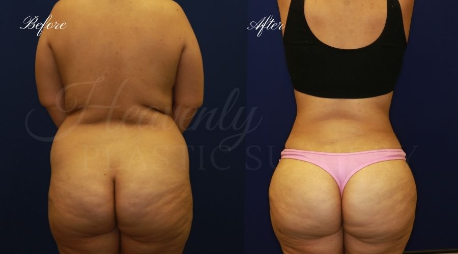 BBL Orange county, brazilian butt lift orange county, brazilian butt lift before and after, brazilian butt lift surgeon, brazilian butt lift results, bbl surgeon, bbl results, bbl before and after, fat transfer to the butt, butt augmentation, butt augmentation surgery, butt augmentation surgeon