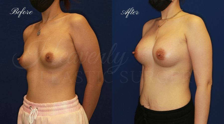 breast augmentation, breast augmentation surgery, breast augmentation surgeon, breast augmentation orange county, breast augmentation with silicone implants, sientra implants, boob job, boob job surgeon, breast implant surgeon, plastic surgery orange county, lake forest plastic surgeon, breast augmentation lake forest, south oc plastic surgeon