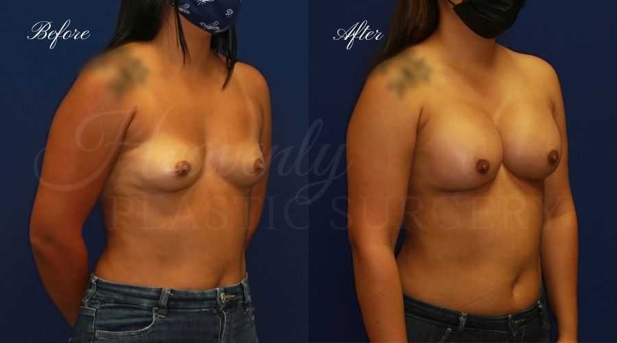 Plastic Surgery, Plastic surgeon, breast augmentation, breast implants, augmentation mammaplasty