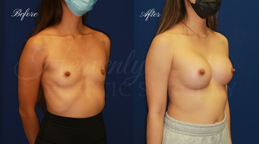 breast augmentation, breast augmentation surgery, breast augmentation surgeon, breast augmentation orange county, breast augmentation with silicone implants, sientra implants, boob job, boob job surgeon, breast implant surgeon, plastic surgery orange county, lake forest plastic surgeon, breast augmentation lake forest, south oc plastic surgeon