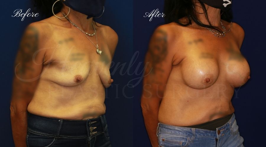 breast augmentation before and after, breast augmentation results, breast augmentation surgery, breast implants before and after, breast implants results, plastic surgery before and after, plastic surgery results, plastic surgeon, breast surgeon, breast augmentation surgeon, breast implant surgeon, breast implants orange county, breast augmentation orange county, orange county plastic surgeon, plastic surgery check