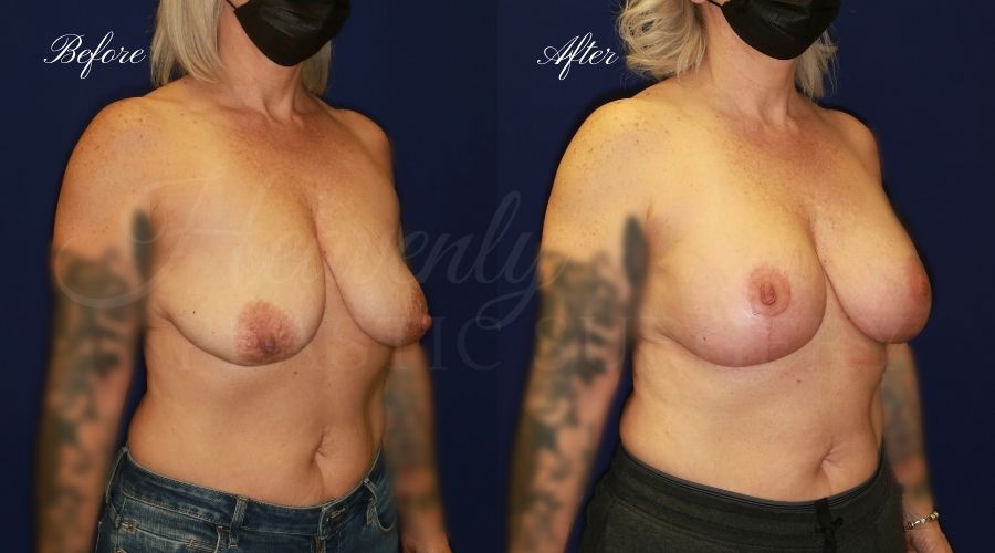 Mastopexy Augmentation (Breast Implants with Lift) - 310cc SRM Silicone breast implants with Wise-pattern breast lift (Anchor scar)