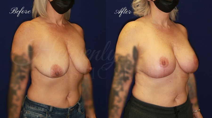 Mastopexy Augmentation (Breast Implants with Lift) - 310cc SRM Silicone breast implants with Wise-pattern breast lift (Anchor scar) Mastopexy Augmentation (Breast Implants with Lift) - 310cc SRM Silicone breast implants with Wise-pattern breast lift (Anchor scar)