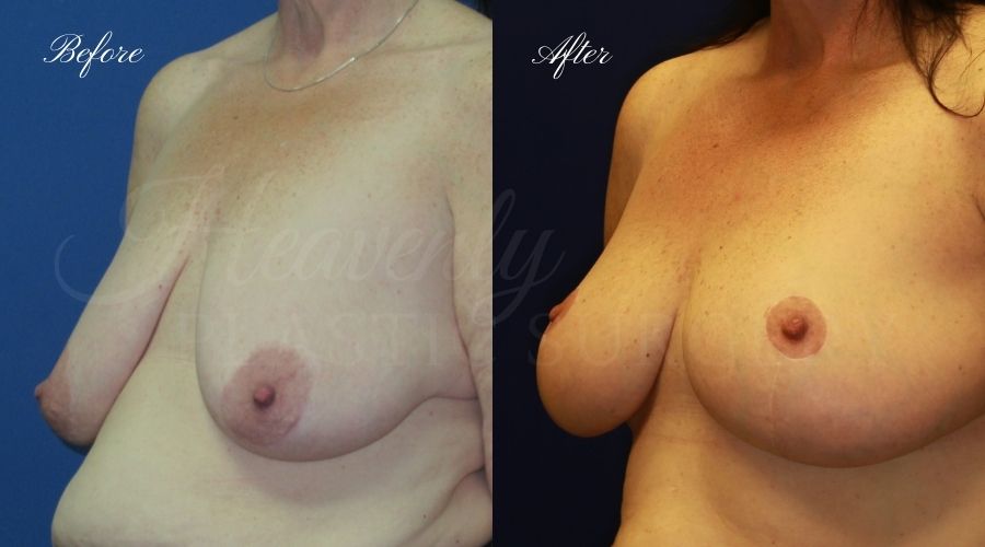 Plastic surgery, plastic surgeon, before and after breast lift, breast lift, mastopexy