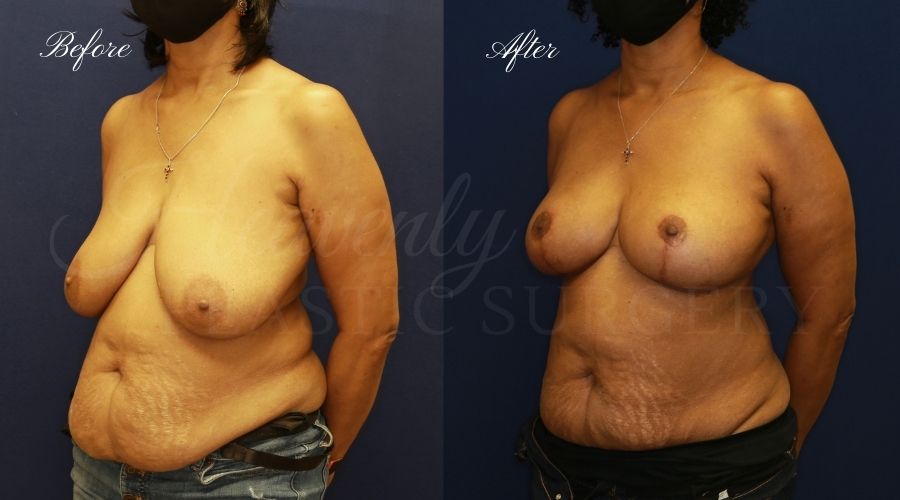 Breast lift surgery, breast lift, breast lift surgeon, mastopexy, mastopexy surgery, breast lift without implants, breast lift orange county, plastic surgery before and after, breast lift before and after, breast lift results, breast reduction, breast reduction results, plastic surgeon, plastic surgery, orange county plastic surgery, orange county plastic surgeon