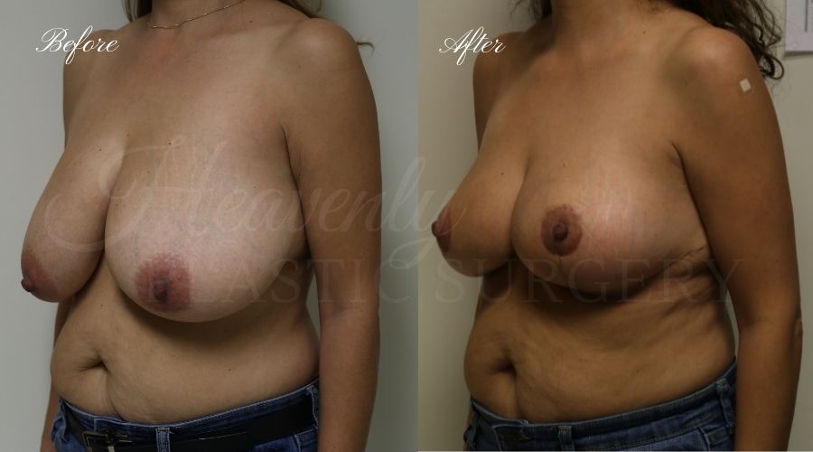 Plastic surgery, plastic surgeon, before and after breast reduction, breast lift, mastopexy, reduction mammaplasty