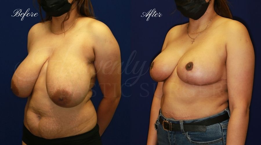 Breast lift surgery, breast lift, breast lift surgeon, mastopexy, mastopexy surgery, breast lift without implants, breast lift orange county, plastic surgery before and after, breast lift before and after, breast lift results, breast reduction, breast reduction results, plastic surgeon, plastic surgery, orange county plastic surgery, orange county plastic surgeon