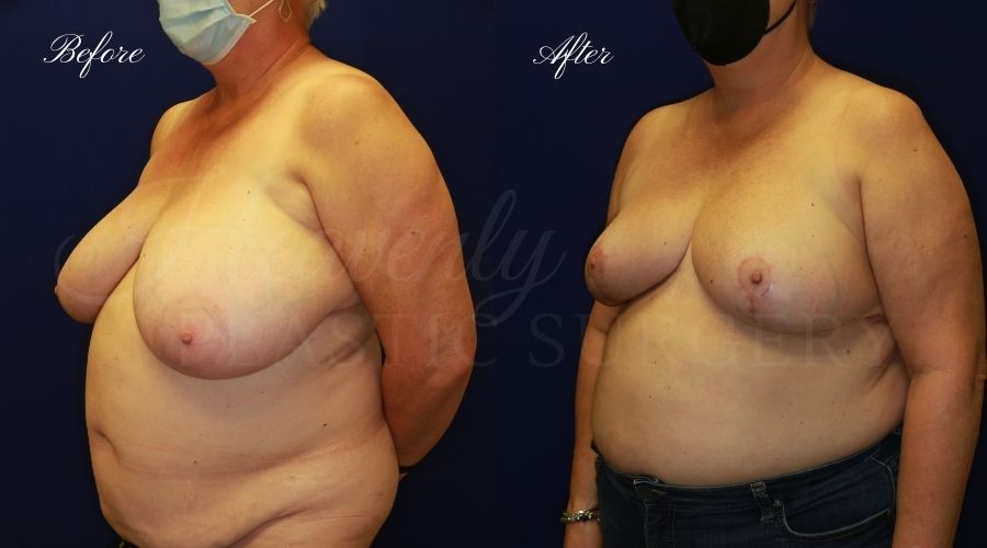 Plastic surgery, plastic surgeon, before and after breast reduction, breast lift, mastopexy, reduction mammaplasty