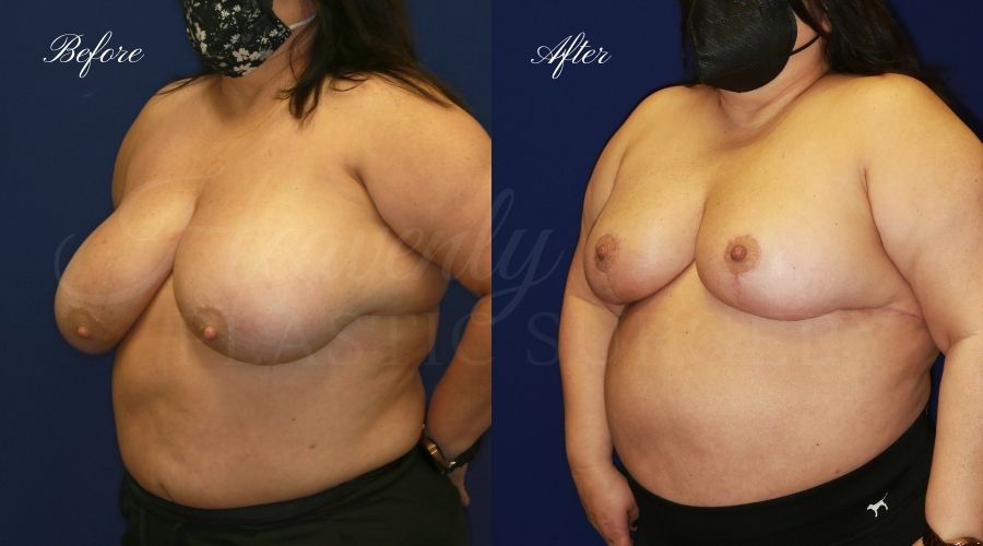 Breast lift surgery, breast lift, breast lift surgeon, mastopexy, mastopexy surgery, breast lift without implants, breast lift orange county, plastic surgery before and after, breast lift before and after, breast lift results, breast reduction, breast reduction results, plastic surgeon, plastic surgery, orange county plastic surgery, orange county plastic surgeon