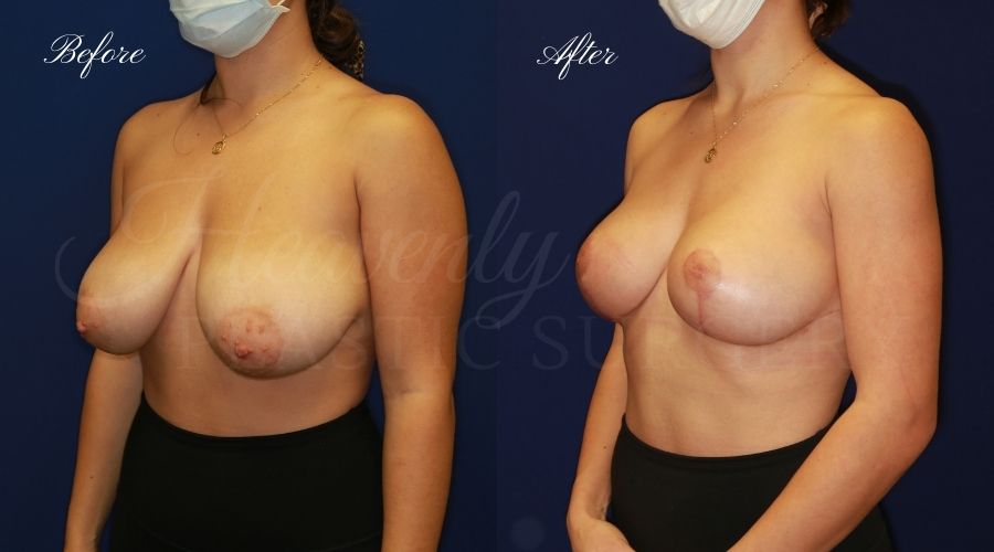 Breast lift surgery, breast lift, breast lift surgeon, mastopexy, mastopexy surgery, breast lift without implants, breast lift orange county, plastic surgery before and after, breast lift before and after, breast lift results, breast reduction, breast reduction results, plastic surgeon, plastic surgery, orange county plastic surgery, orange county plastic surgeon