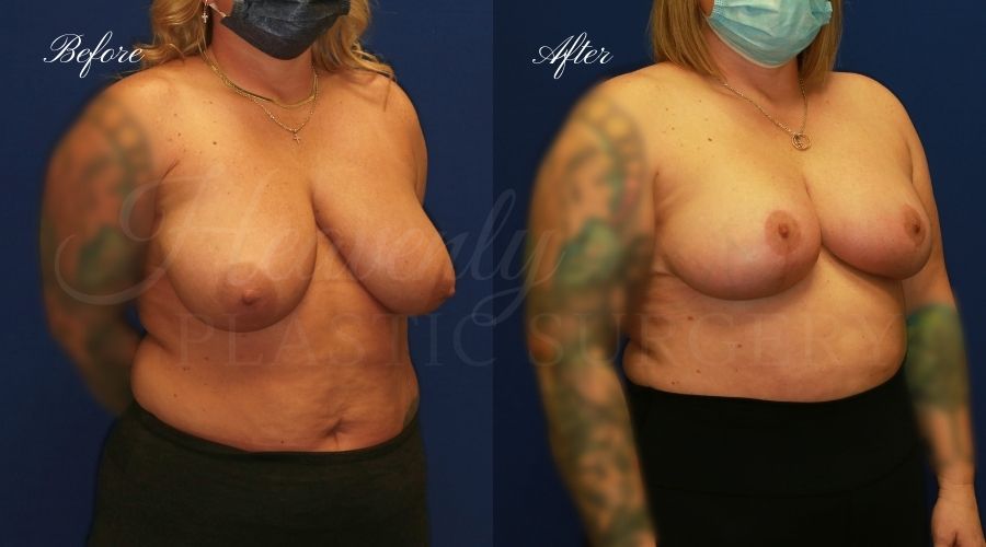 Plastic surgery, plastic surgeon, breast reduction, breast lift, reduction mammaplasty, mastopexy, before and after