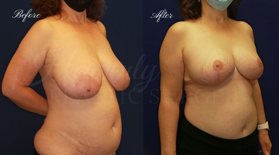 Breast lift surgery, breast lift, breast lift surgeon, mastopexy, mastopexy surgery, breast lift without implants, breast lift orange county, plastic surgery before and after, breast lift before and after, breast lift results, breast reduction, breast reduction results, plastic surgeon, plastic surgery, orange county plastic surgery, orange county plastic surgeon