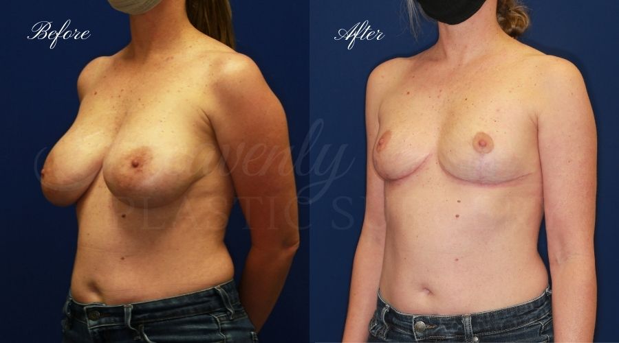 Breast Implant Removal + Breast Lift, Explant and Breast Lift, Breast Explant, Mastopexy, IMplant removal and mastopexy, plastic surgery before and after, plastic surgery revision, implant removal before and after, breast implant removal before and after, breast implant removal surgeon, breast implant removal orange county