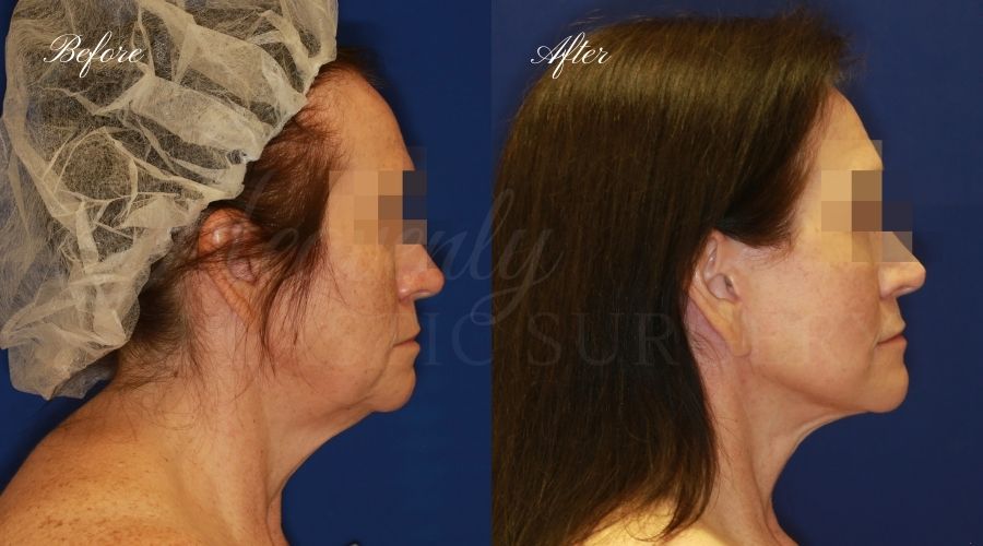 face lift, cosmetic surgery, neck lift, plastic surgery, before and after face lift, face surgery, plastic surgery, facelift, necklift, c02 laser, laser treatment, laser treatment before and after, laser skincare,