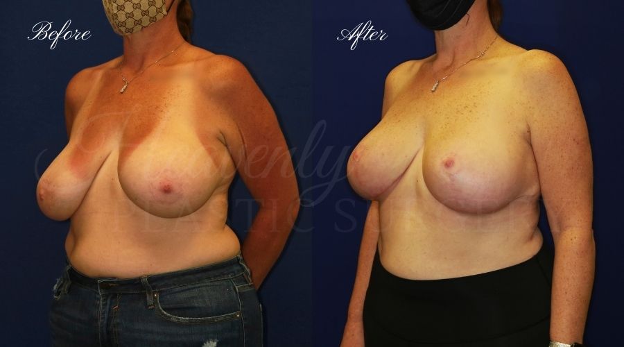 Breast Implant Exchange and Breast Lift - 310cc SRM Silicone Implants with Wise pattern Mastopexy (Anchor Scar)