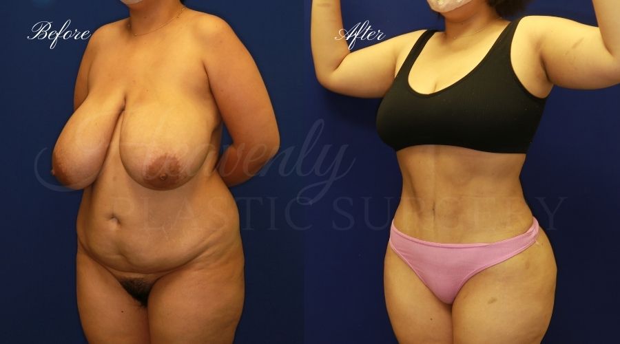 BBL Orange county, brazilian butt lift orange county, brazilian butt lift before and after, brazilian butt lift surgeon, brazilian butt lift results, bbl surgeon, bbl results, bbl before and after, fat transfer to the butt, butt augmentation, butt augmentation surgery, butt augmentation surgeon BBL Orange county, brazilian butt lift orange county, brazilian butt lift before and after, brazilian butt lift surgeon, brazilian butt lift results, bbl surgeon, bbl results, bbl before and after, fat transfer to the butt, butt augmentation, butt augmentation surgery, butt augmentation surgeon