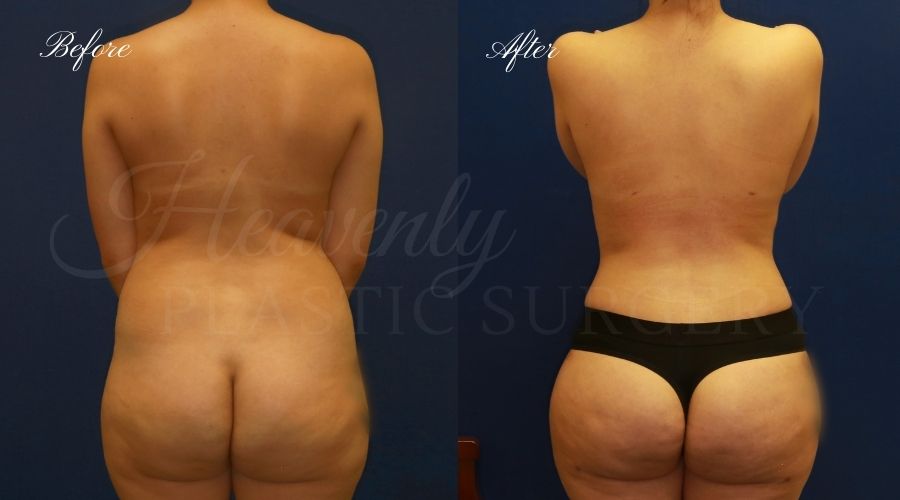 Mommy makeover before and after, mommy makeover surgery, breast augmentation surgery, tummy tuck surgery, breast augmentation before and after, tummy tuck before and after, mommy makeover surgeon, mommy makeover surgery, mommy makeover orange county, tummy tuck orange county, breast augmentationorange county, plastic surgery, plastic surgeon, plastic surgery before and after, mommy makeover journey, mommy makeover results, tummy tuck journey, tummy tuck results, plastic surgery results, orange county plastic surgeon, orange county plastic surgery, plastic surgery orange county, breast implants, breast implants orange county Mommy makeover before and after, mommy makeover surgery, breast augmentation surgery, tummy tuck surgery, breast augmentation before and after, tummy tuck before and after, mommy makeover surgeon, mommy makeover surgery, mommy makeover orange county, tummy tuck orange county, breast augmentationorange county, plastic surgery, plastic surgeon, plastic surgery before and after, mommy makeover journey, mommy makeover results, tummy tuck journey, tummy tuck results, plastic surgery results, orange county plastic surgeon, orange county plastic surgery, plastic surgery orange county, breast implants, breast implants orange county