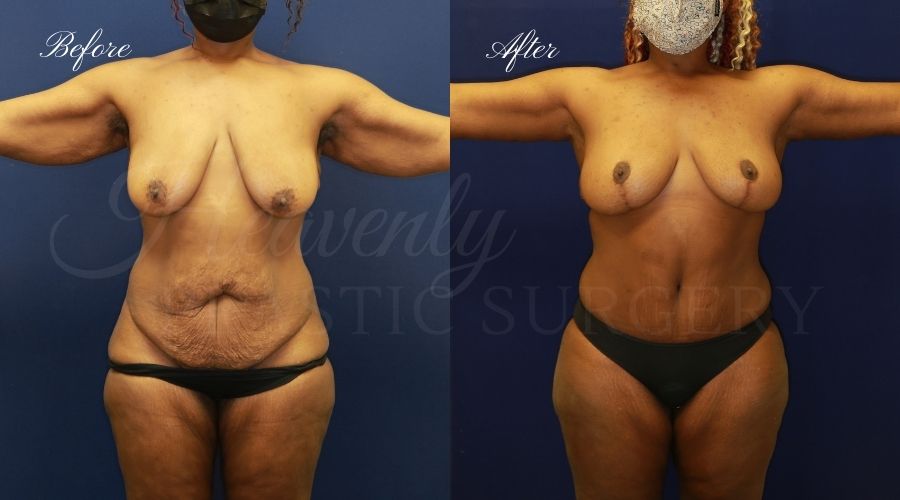 mommy makeover before and after, arm lift before and after, breast lift before and after, tummy tuck before and after, mommy makeover orange county, orange county plastic surgeon, mommy makeover surgeon, tummy tuck orange county, breast lift orange county, arm lift orange county, breast lift with no implants