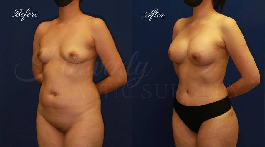 Mommy makeover before and after, mommy makeover surgery, breast augmentation surgery, tummy tuck surgery, breast augmentation before and after, tummy tuck before and after, mommy makeover surgeon, mommy makeover surgery, mommy makeover orange county, tummy tuck orange county, breast augmentationorange county, plastic surgery, plastic surgeon, plastic surgery before and after, mommy makeover journey, mommy makeover results, tummy tuck journey, tummy tuck results, plastic surgery results, orange county plastic surgeon, orange county plastic surgery, plastic surgery orange county, breast implants, breast implants orange county Mommy makeover before and after, mommy makeover surgery, breast augmentation surgery, tummy tuck surgery, breast augmentation before and after, tummy tuck before and after, mommy makeover surgeon, mommy makeover surgery, mommy makeover orange county, tummy tuck orange county, breast augmentationorange county, plastic surgery, plastic surgeon, plastic surgery before and after, mommy makeover journey, mommy makeover results, tummy tuck journey, tummy tuck results, plastic surgery results, orange county plastic surgeon, orange county plastic surgery, plastic surgery orange county, breast implants, breast implants orange county
