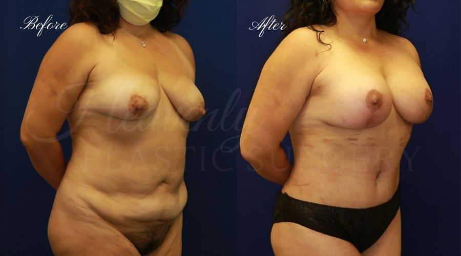 Mommy makeover before and after, mommy makeover surgery, breast lift surgery, tummy tuck surgery, breast lift before and after, tummy tuck before and after, mommy makeover surgeon, mommy makeover surgery, mommy makeover orange county, tummy tuck orange county, breast lift orange county, plastic surgery, plastic surgeon, plastic surgery before and after, mommy makeover journey, mommy makeover results, tummy tuck journey, tummy tuck results, plastic surgery results, orange county plastic surgeon, orange county plastic surgery, plastic surgery orange county Mommy makeover before and after, mommy makeover surgery, breast lift surgery, tummy tuck surgery, breast lift before and after, tummy tuck before and after, mommy makeover surgeon, mommy makeover surgery, mommy makeover orange county, tummy tuck orange county, breast lift orange county, plastic surgery, plastic surgeon, plastic surgery before and after, mommy makeover journey, mommy makeover results, tummy tuck journey, tummy tuck results, plastic surgery results, orange county plastic surgeon, orange county plastic surgery, plastic surgery orange county