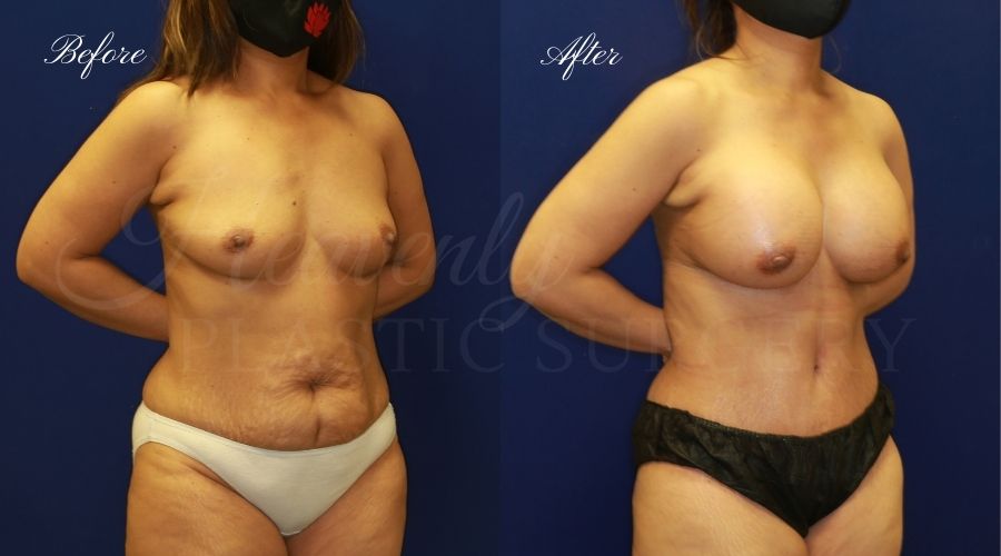 Mommy makeover before and after, breast augmentation before and after, tummy tuck before and after, mommy makeover results, mommy makeover surgeon, breast augmentation surgeon, breast implant surgeon, breast implant surgery, tummy tuck surgeon, abdominoplasty, abdominoplasty surgeon, orange county plastic surgeon, breast implants orange county, tummy tuck orange county, orange county plastic surgeon Mommy makeover before and after, breast augmentation before and after, tummy tuck before and after, mommy makeover results, mommy makeover surgeon, breast augmentation surgeon, breast implant surgeon, breast implant surgery, tummy tuck surgeon, abdominoplasty, abdominoplasty surgeon, orange county plastic surgeon, breast implants orange county, tummy tuck orange county, orange county plastic surgeon