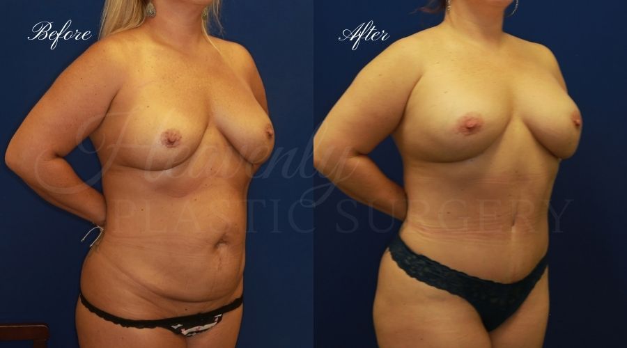 Mommy makeover before and after, mommy makeover surgery, breast augmentation surgery, tummy tuck surgery, breast augmentation before and after, tummy tuck before and after, mommy makeover surgeon, mommy makeover surgery, mommy makeover orange county, tummy tuck orange county, breast augmentationorange county, plastic surgery, plastic surgeon, plastic surgery before and after, mommy makeover journey, mommy makeover results, tummy tuck journey, tummy tuck results, plastic surgery results, orange county plastic surgeon, orange county plastic surgery, plastic surgery orange county, breast implants, breast implants orange county Mommy makeover before and after, mommy makeover surgery, breast augmentation surgery, tummy tuck surgery, breast augmentation before and after, tummy tuck before and after, mommy makeover surgeon, mommy makeover surgery, mommy makeover orange county, tummy tuck orange county, breast augmentationorange county, plastic surgery, plastic surgeon, plastic surgery before and after, mommy makeover journey, mommy makeover results, tummy tuck journey, tummy tuck results, plastic surgery results, orange county plastic surgeon, orange county plastic surgery, plastic surgery orange county, breast implants, breast implants orange county