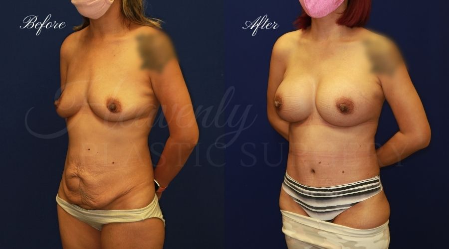 Mommy makeover before and after, breast augmentation before and after, tummy tuck before and after, mommy makeover results, mommy makeover surgeon, breast augmentation surgeon, breast implant surgeon, breast implant surgery, tummy tuck surgeon, abdominoplasty, abdominoplasty surgeon, orange county plastic surgeon, breast implants orange county, tummy tuck orange county, orange county plastic surgeon