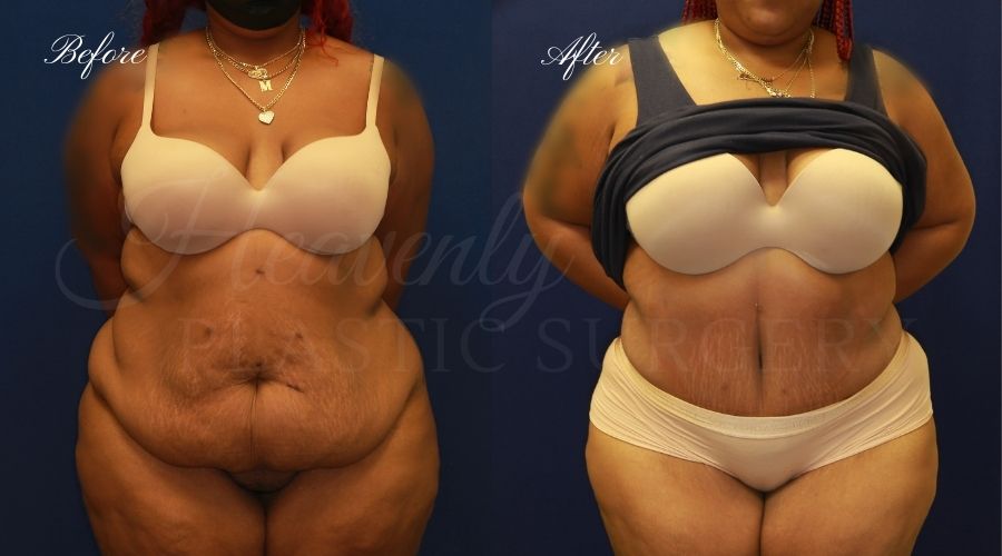 Plastic Surgery, Plastic Surgeon, Tummy Tuck, Abdominoplasty, Tummy Tuck with Lipo, Liposuction, Orange County Plastic Surgeon, Orange County Plastic Surgery, Fupa, Fupa surgery, fupa surgeon